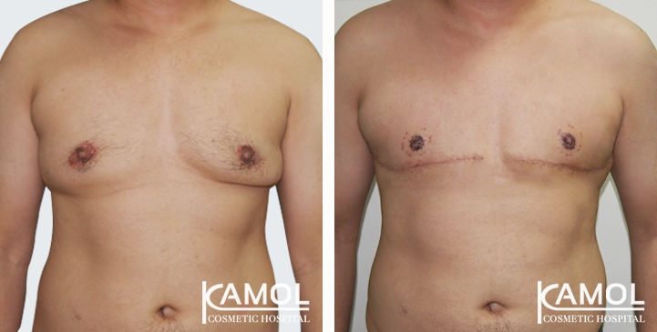 Gynecomastia surgery