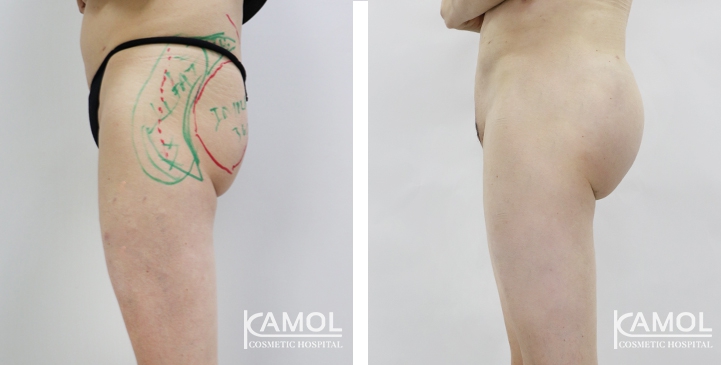 Buttock Augmentation 360 CC