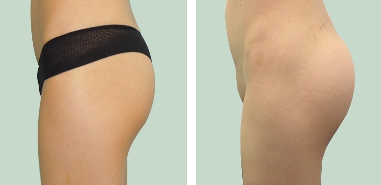 Buttock Augmentation 300 CC