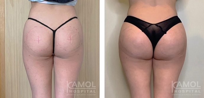 Buttock Augmentation 400 CC