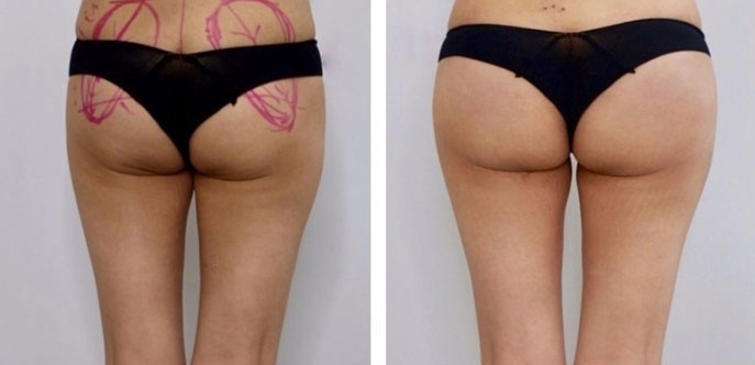 Buttock Augmentation 300 CC