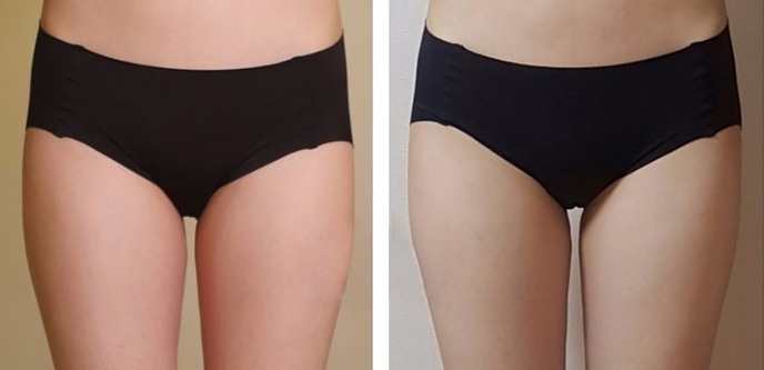 Buttock Augmentation 300 CC