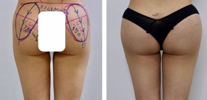 Buttock Augmentation 400 CC