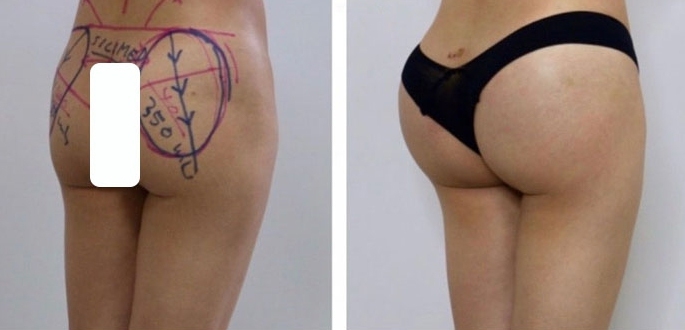 Buttock Augmentation 400 CC