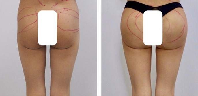 Buttock Augmentation 400 CC