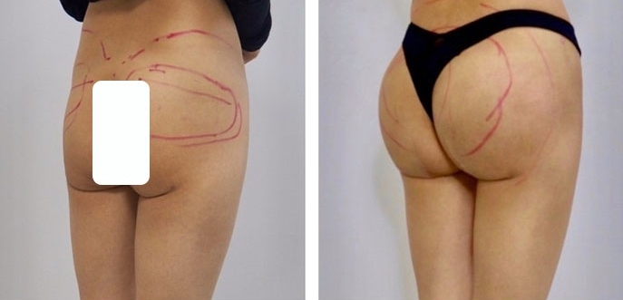 Buttock Augmentation 400 CC