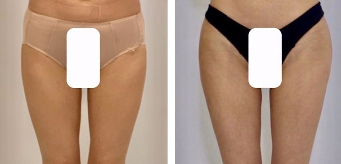 Buttock Augmentation 400 CC