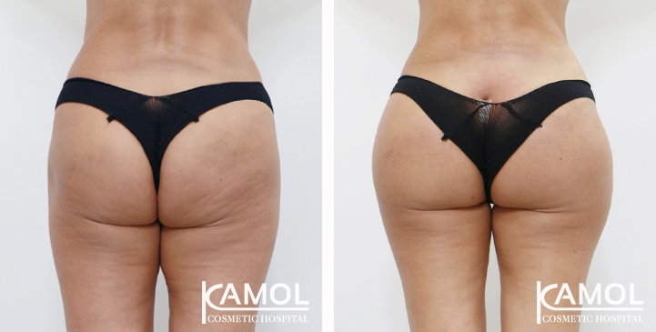 Buttock Augmentation 360 CC