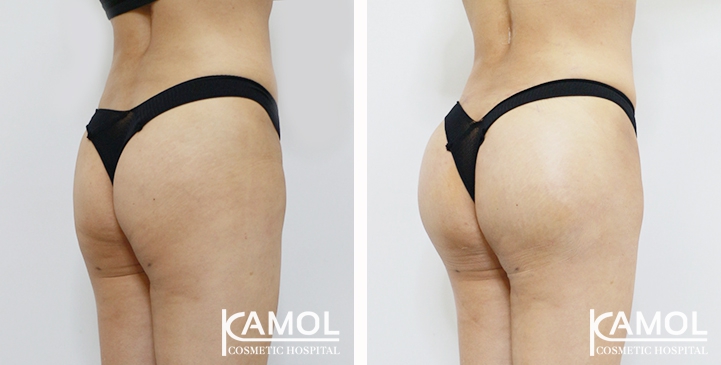 Buttock Augmentation 360 CC