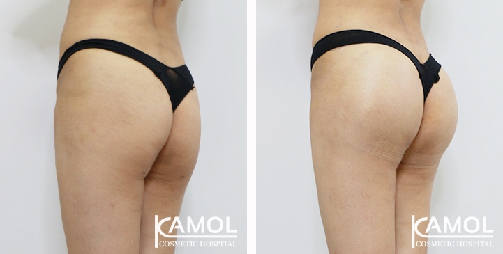 Buttock Augmentation 360 CC