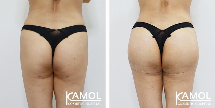 Buttock Augmentation 360 CC