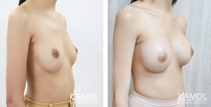 Breast Augmentation