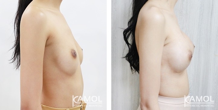 Breast Augmentation