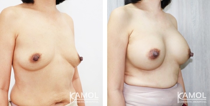 Breast Augmentation