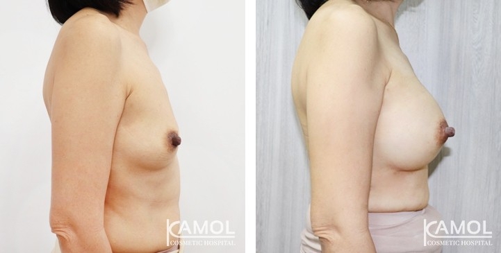 Breast Augmentation