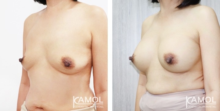 Breast Augmentation