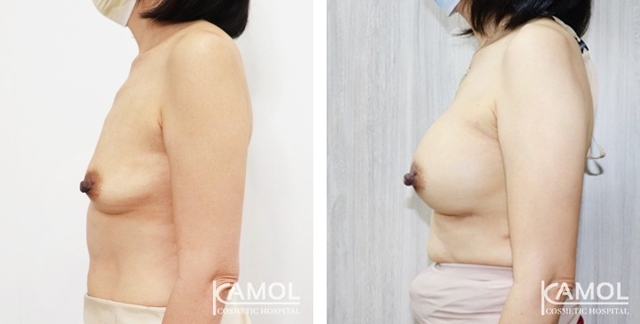 Breast Augmentation