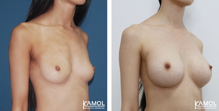 Breast Augmentation