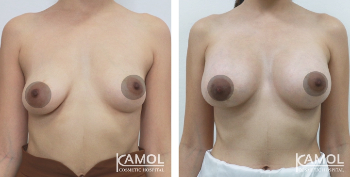 Breast Augmentation