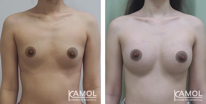 Breast Augmentation