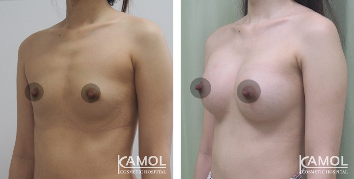 Breast Augmentation