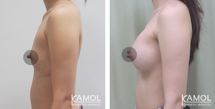 Breast Augmentation