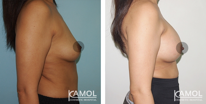 Breast Augmentation