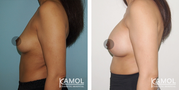 Breast Augmentation