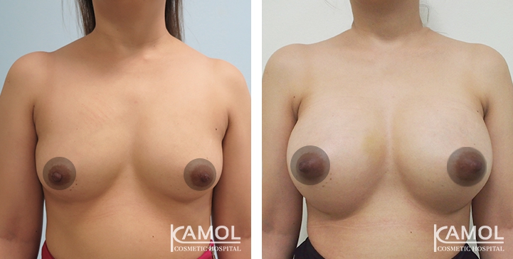 Breast Augmentation