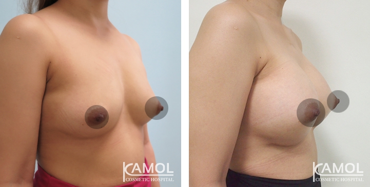 Breast Augmentation