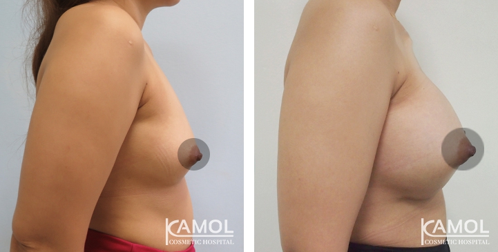 Breast Augmentation