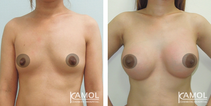 Breast Augmentation