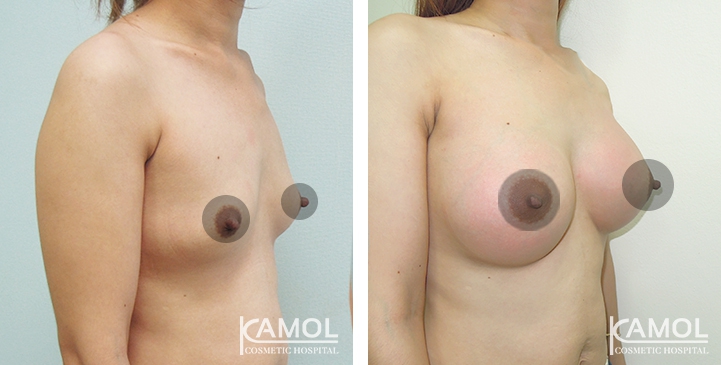 Breast Augmentation