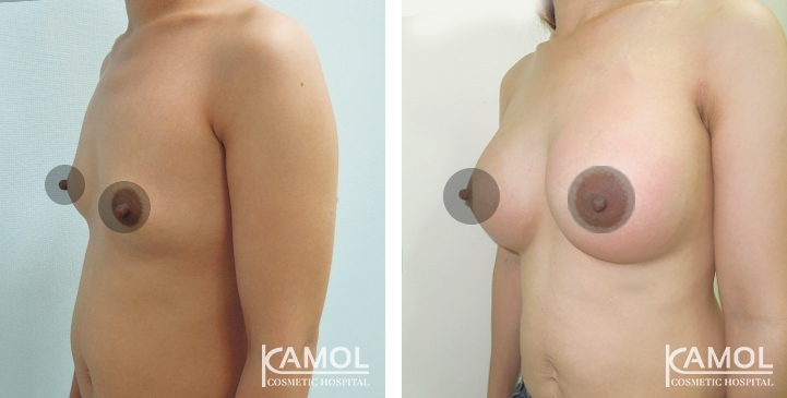 Breast Augmentation