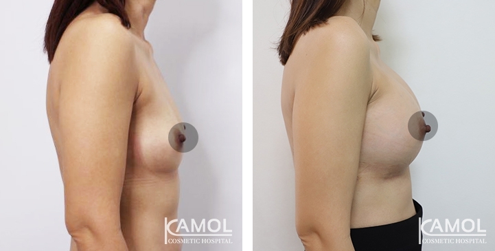 Breast Augmentation