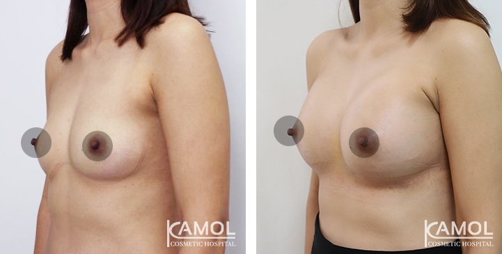 Breast Augmentation