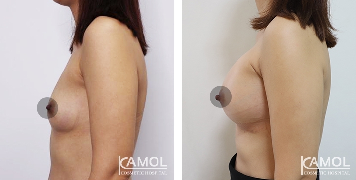 Breast Augmentation