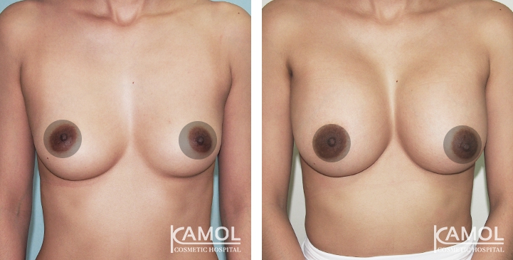 Breast Augmentation