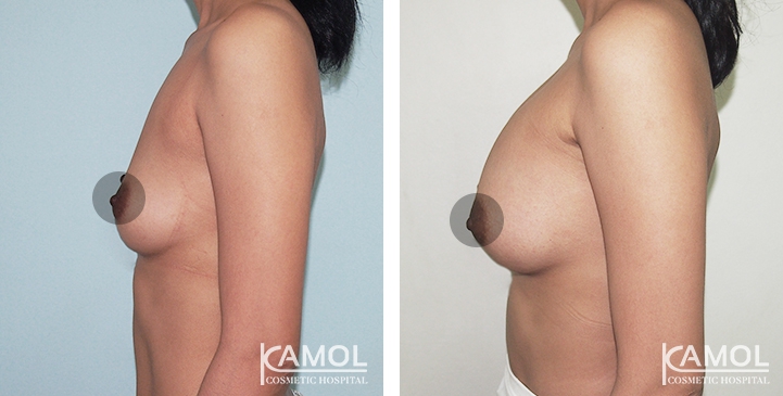 Breast Augmentation