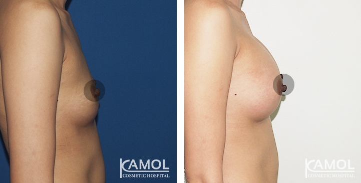 Breast Augmentation