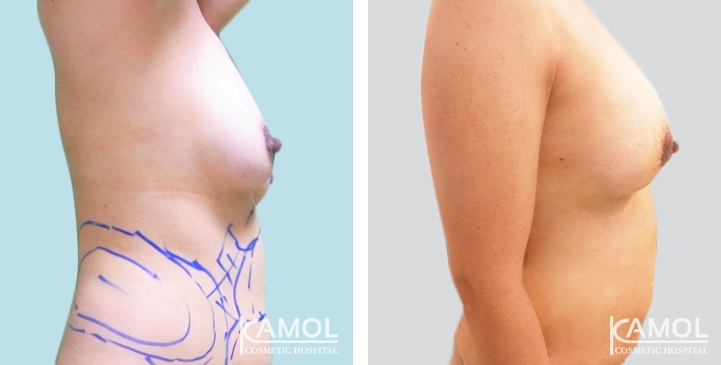 Breast Lift by Incision Scar around Areola (O scar) with implant 