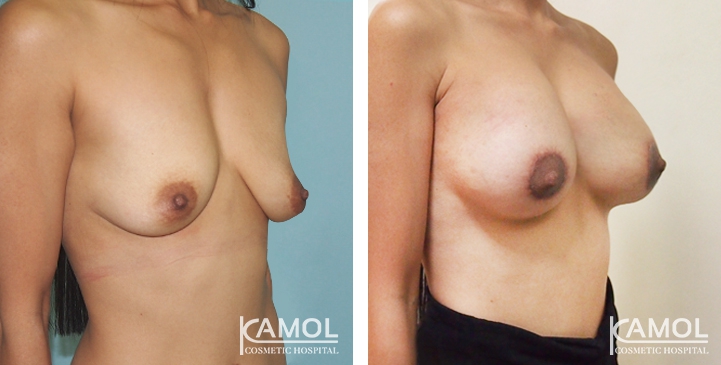 Breast Lift by Incision Scar around Areola (O scar) with implant 