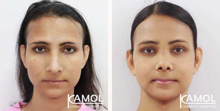 Facial Feminization Surgery