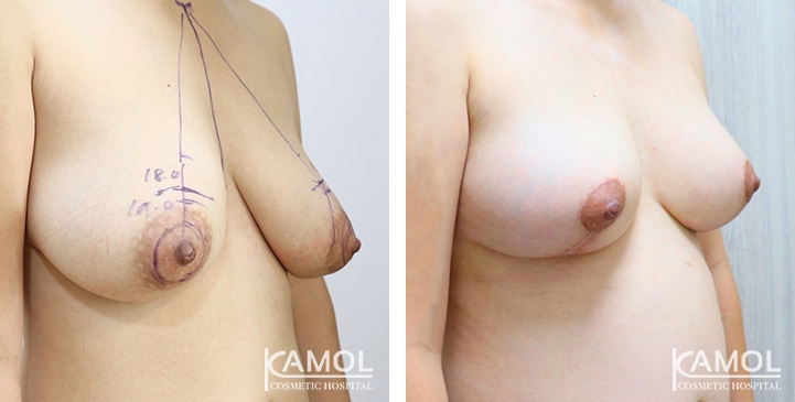 Before and After surgery 1 months Breast Lift by Inverted T-scar