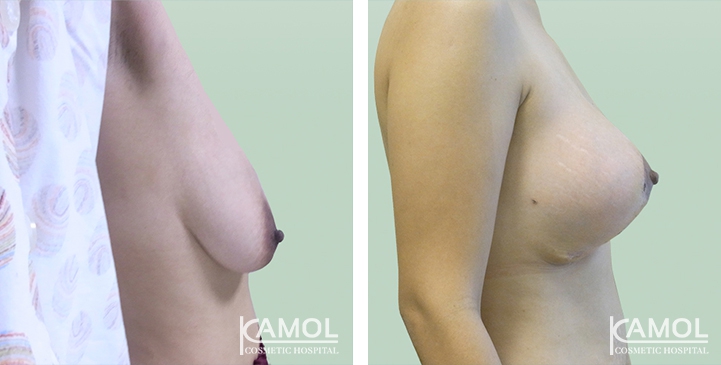 Before and After surgery 2 weeks Breast Reduction by inverted T-scar