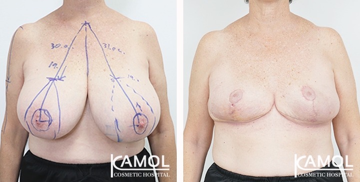  Breast lift and breast reduction after surgery 30 days 