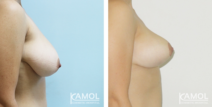 Before and After surgery 1 month Breast Reduction by inverted T-scar