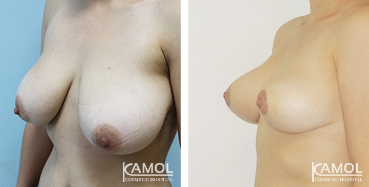 Before and After surgery 1 month Breast Reduction by inverted T-scar