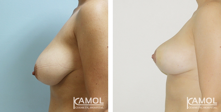 Before and After surgery 1 month Breast Reduction by inverted T-scar