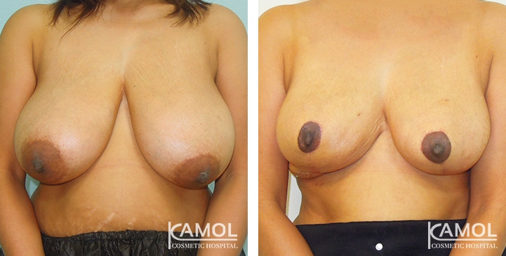 Before and After surgery 1 month Breast Reduction by inverted T-scar